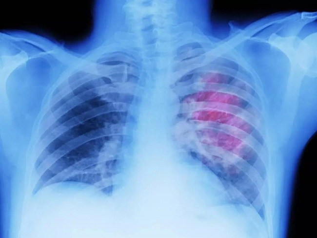 Lungs and lung cancer